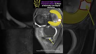 Fig 1B07 Fullthickness Radial Meniscal Tears [upl. by Blackwell611]