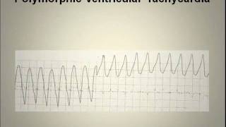 ECG Interpretation Video Lecture Module 5A of 6 [upl. by Hgielrebma]