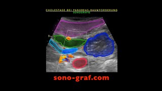 Sonographie  Cholestase bei Pankreaskopf Raumforderung [upl. by Grange978]