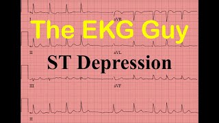 EKGECG STsegment Depression  Question 150  The EKG Guy [upl. by Brigit]