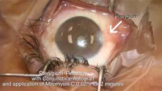 Pterygium removal with conjunctival autograft and mitomycin C Shannon Wong MD 52817 [upl. by Nellie]