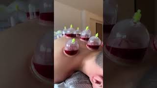 Hidžama cupping therapy hejama [upl. by Einnaoj924]