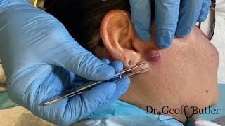 Drainage of an infected cyst in front of the ear [upl. by Ocin]