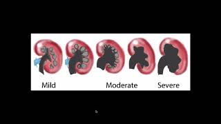 Hydronephrosis  Ultrasound [upl. by Nosreme]