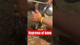 Hygroma Knee dr Umar khan [upl. by Lumbard]