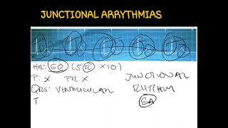 ECGJunctional Arrythmias [upl. by Dennie]