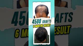 Low Donor Hair Transplant lowdonorareahairtransplant hair shorts ytshorts [upl. by Eciral]