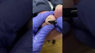 Diabetic Ulcer FollowUp Expert Callus Removal by Australian Podiatrist [upl. by Maxim]