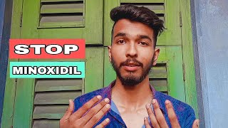 6 months minoxidil beard growth journey results review how to grow beard 🪴 minoxidil beard [upl. by Ellecrad]