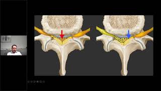 Der zu enge Wirbelkanal der Hals und Lendenwirbelsäule Spinalstenose minimal invasive Mikrochirurg [upl. by Smoht]