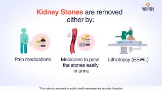 Kidney Stone Removal  Kidney Stone Causes Signs and Treatment Methods [upl. by Reppiks441]