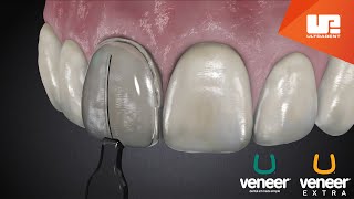 Uveneer® Procedure Animation  Direct Veneer Template System [upl. by Netsirhk26]