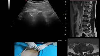 Ultrasound guided transforaminal epidural steroid injection [upl. by Ronica]