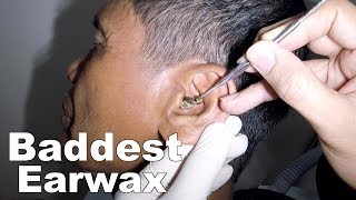 Removing Mans Baddest Earwax  Watch How Its Done [upl. by Amehsat187]