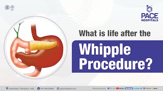 What is life after the Whipple Procedure  PACE Hospitals shortvideo whippleprocedure [upl. by Anai]