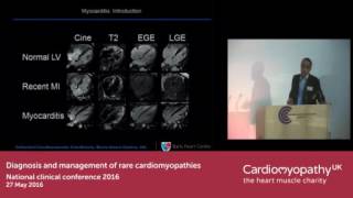 When to suspect myocarditis [upl. by Haikezeh]