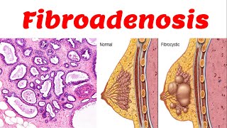 4 Fibrocytic Disease  Fibroadenosis [upl. by Saleme]