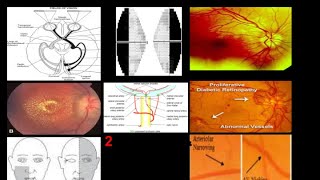 Optic Tract pupillary light reflex Ophthalmoscopy Papilledema PseudoPapilledema Retinopathies [upl. by Nolyk]