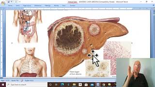 Hepatic disorders in Arabic 9  Amoebic liver abscess  by Dr Wahdan [upl. by Ailekat30]