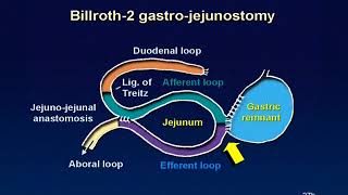 01 Billroth 2 reconstruction animation [upl. by Dranoel]