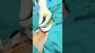 central line insertion steps femoral line insertion procedure central line kaise dalte hain [upl. by Paine]