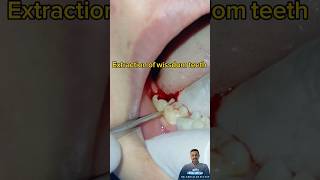 خلع ضرس العقل خلع الأسنان بدون ألم  extraction of wissdom teeth extractionteeth dentist [upl. by Alben841]