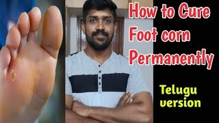 Foot Cornఆనెలు నివారణ మార్గాలు foot corn Permanent cure  Telugu  Lohisya media [upl. by Carmita776]