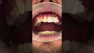 Veneers process by Dr Nabeel dentalveneers dentalesthetics cosmeticdentistry [upl. by Ahsenod]