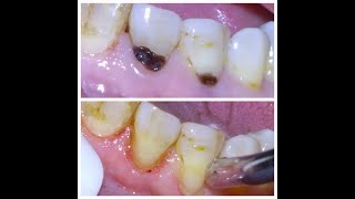 16 Repair of tooth decay at gumline [upl. by Nomyad612]