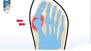 How to Correct an Hallux Valgus and Relieve Bunion Pain  EPITACT at Boots [upl. by Denver]