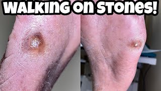 How To Get Rid Of a Stone Callus [upl. by Birdt]