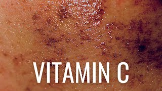 HOW Vitamin C PREVENTS Hyperpigmentation [upl. by Nivlam399]