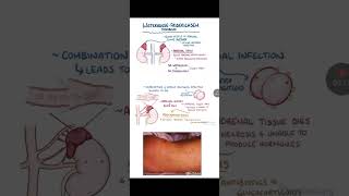 Waterhouse Friderichsen syndrome [upl. by Haroved]