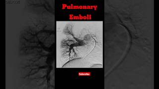 Pulmonary Emboli shorts pulmonaryembolism radiology pulmonarydisease [upl. by Gardel]