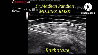 Barbotage of Calcific Tendinitis Rotator cuff [upl. by Inajna]