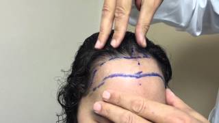 Plastic Surgeon Dr Jeffrey Epstein Solution For HighReceeding Hairline [upl. by Greeley]