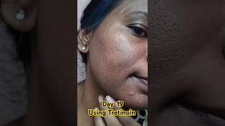 Day19 Using Tretinoin 0025 cream viralvideo tretinoin youtubeshorts skincare shorts [upl. by Jori]