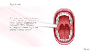 NightLase Snoring and Apnea Treatment [upl. by Ahsir569]