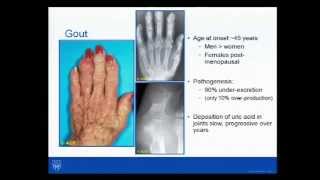 Rheumatology Pearls Dr John M Davis III 82014 [upl. by Arihsaj672]