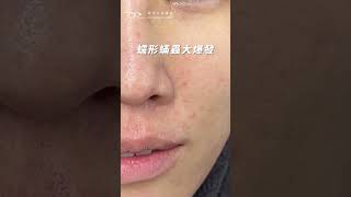 親身實驗！亂敷面膜的後果 面膜 油性肌膚 痘痘 青春痘 痘痘肌 A酸 A醇 蠕型蟎蟲 舒利達 [upl. by Graner286]