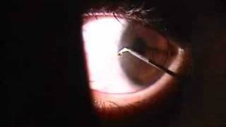 Corneal Foreign Body [upl. by Gillian681]