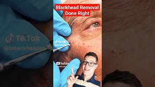 Crazy Satisfying BLACKHEAD REMOVAL  Perfect Extraction shorts [upl. by Jola]