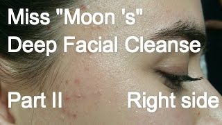 Miss quotMoon squot Deep Facial Cleanse  Part 2 of 2 Right side [upl. by Yarled103]