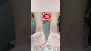 InteractiveDermatology clinic Cases 37 Koilonychia amp 38 Atopic dermatitis [upl. by Leseil]