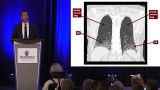 Evaluation and Management of Scleroderma Lung Disease Aryeh Fischer MD 2017 [upl. by Allissa]