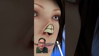 How to do Rhinoplasty greenscreen youtubeshorts viralvideo shorts [upl. by Cox]