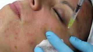 MESOTERAPIA FACIAL CON TERAPIA CELULAR [upl. by Pyotr]