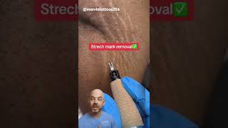 Does this count as a stretch mark removal⁉️ credit marvinstattoos256 on TT doctor satisfying [upl. by Vallery]