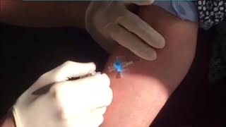 cannulation Technique in ACF [upl. by Leibman]