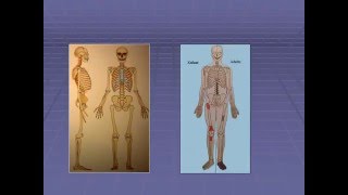 traumatologie L’OSTEOMYELITE AIGUE HEMATOGENE [upl. by Nevet]